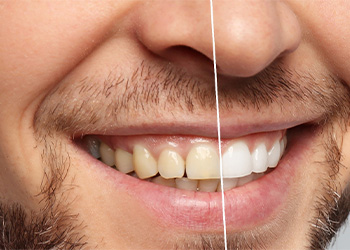 Close-up of smile before and after teeth whitening