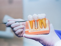 Dentist pointing to parts of dental implant in Jonesboro