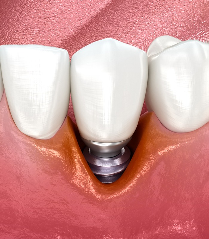 Illustration of receding gums around a dental implant