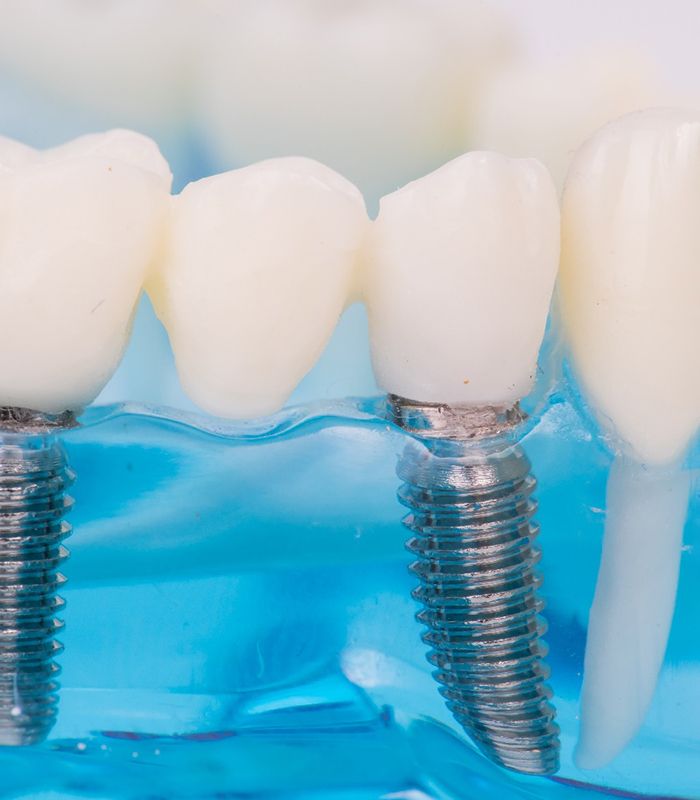 Two dental implants in Jonesboro, AR in a plastic tray