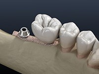 Illustration of dental implants in Jonesboro, AR after bone grafting