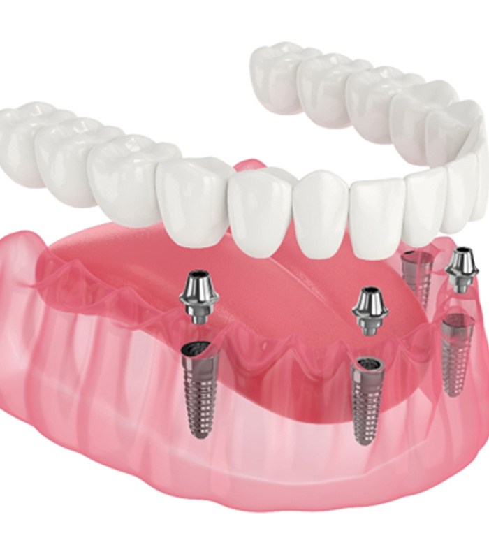 3D graphic of all-on-4 dental implants