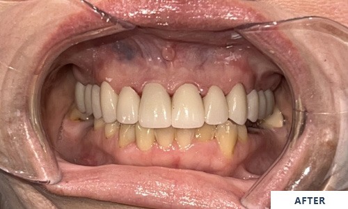 After full mouth treatment
