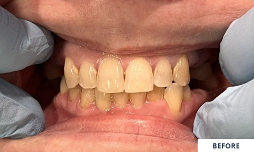 Before full mouth treatment