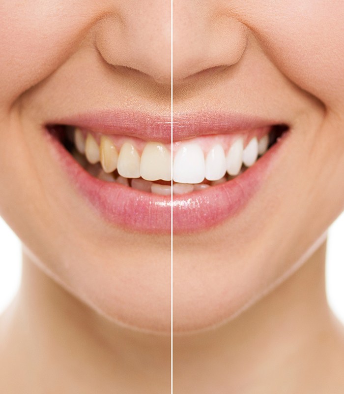 Closeup of smile before and after teeth whitening