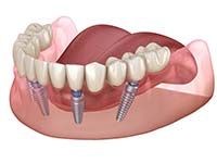 implant denture on the lower arch