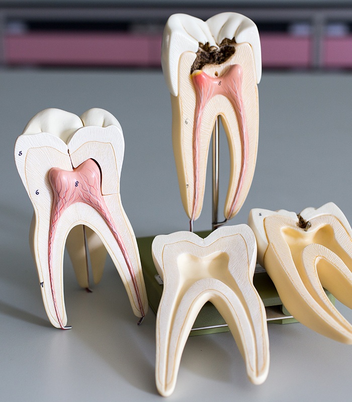 Model healthy tooth and tooth in need of root canal therapy