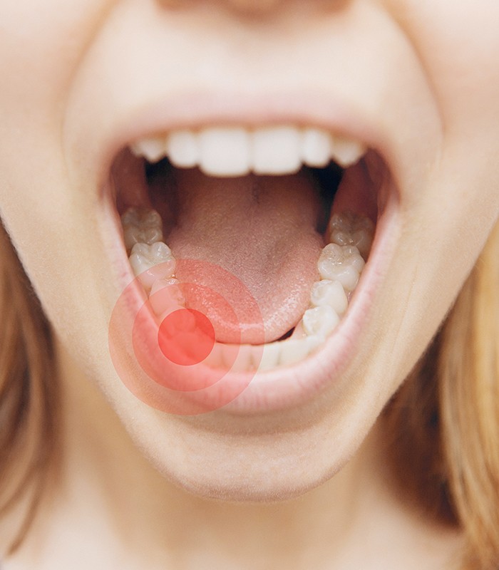 Smile with red circle of tooth in need of extraction