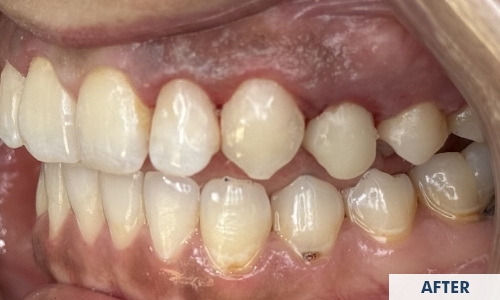 After treatment