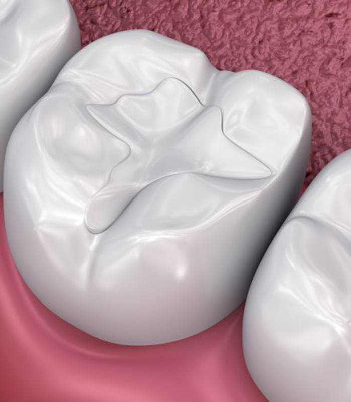 a 3 D illustration of tooth colored fillings