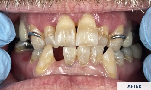 After composite fillings