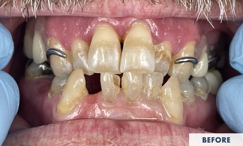 Before composite fillings