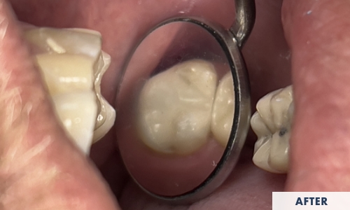 After composite fillings