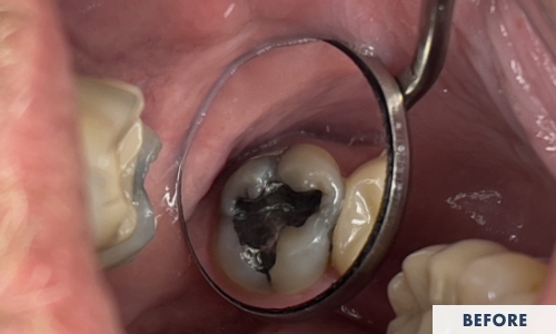 Before composite fillings