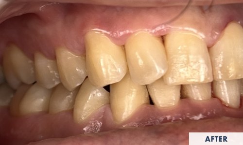 After gum disease treatment