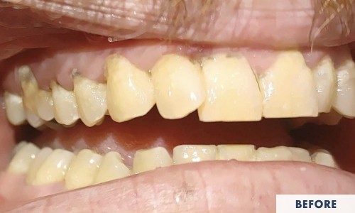 Before gum disease treatment