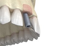 Digital illustration of bone graft for dental implant in Jonesboro