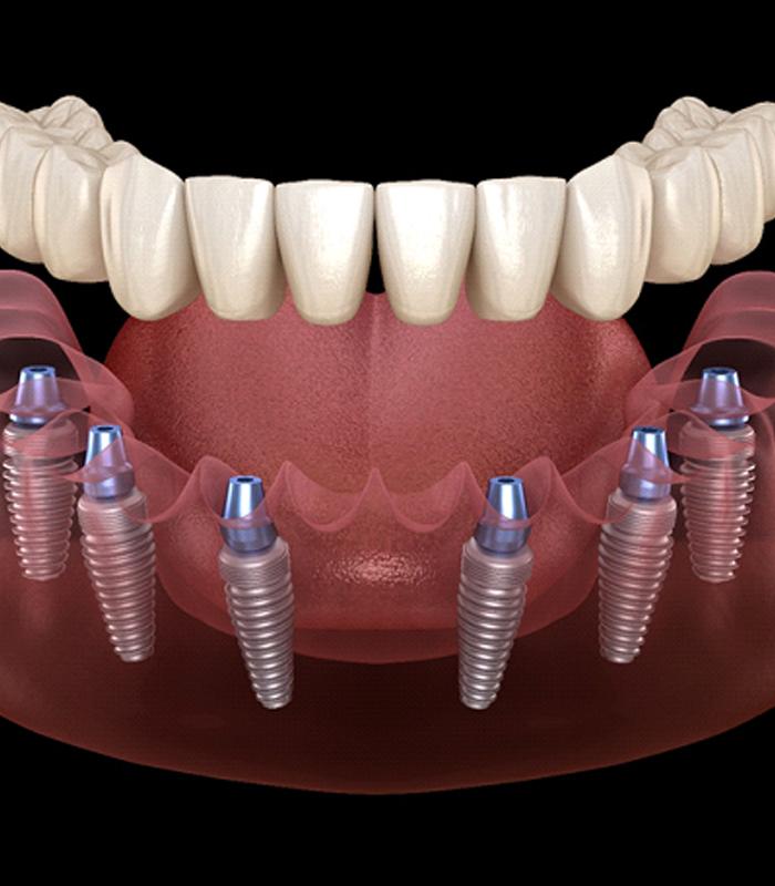 Illustration of implant denture in Jonesboro being attached to dental implants