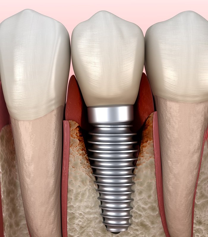 Illustration showing peri-implantitis around a dental implant