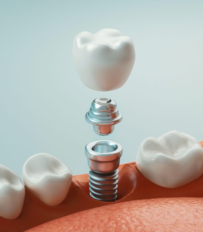 Animated dental implant supported replacement tooth placement