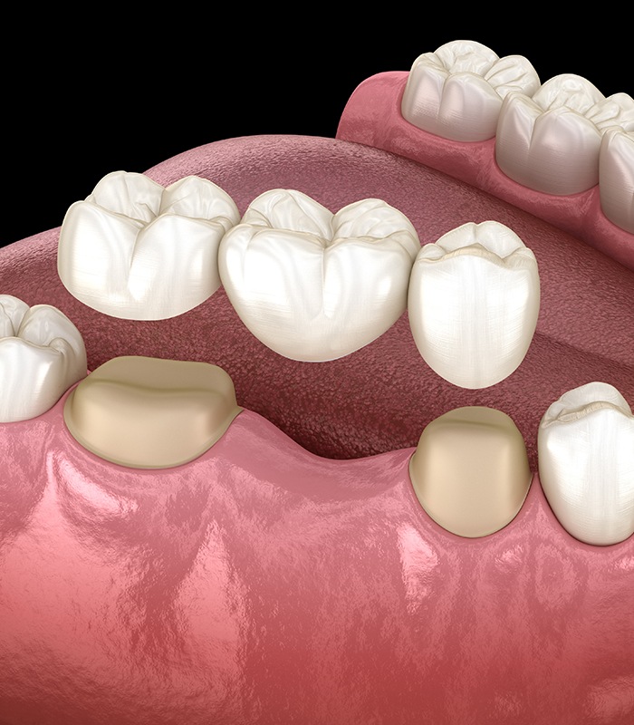 Animated smile during dental bridge tooth replacement