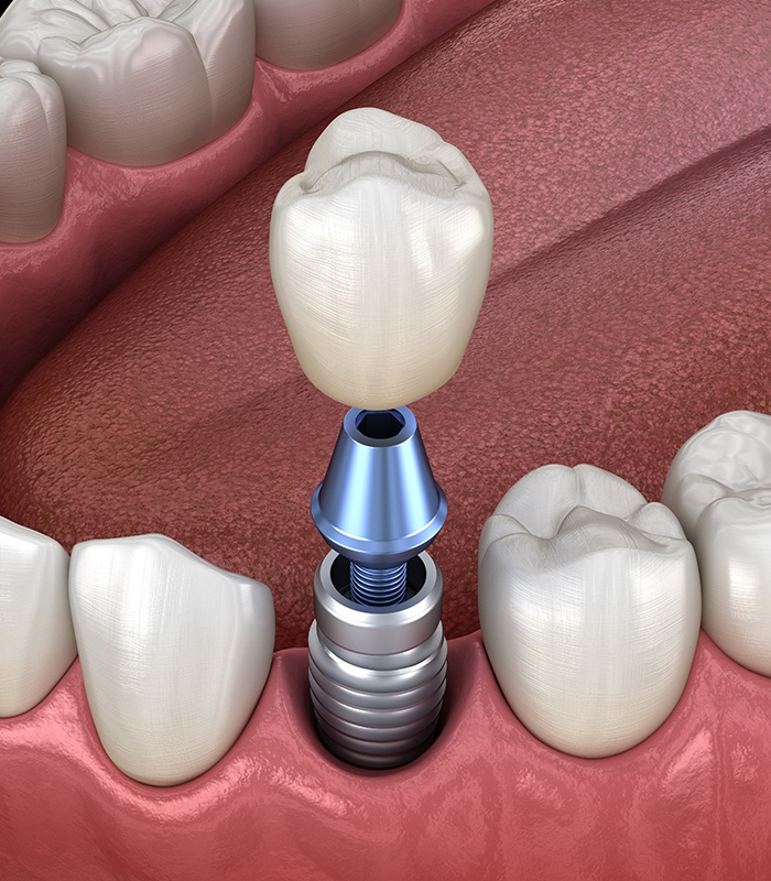 Animated dental implant supported dental crown placement