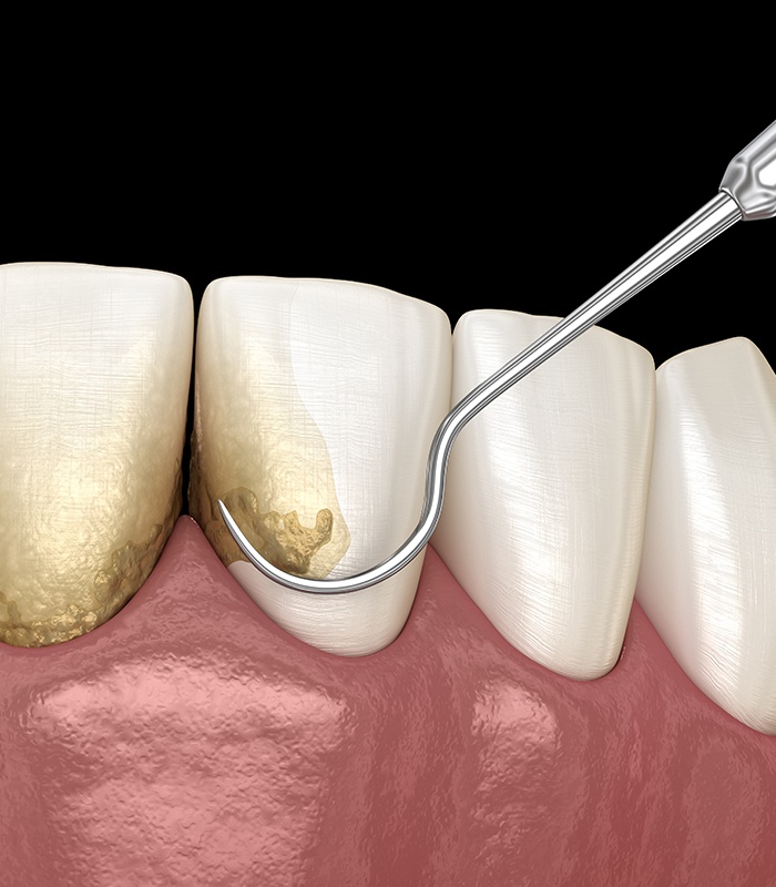 Animated smile during scaling and root planing gum disease treatment