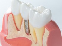 Close-up of a model of a dental implant in Jonesboro, AR after osseointegration