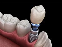 Illustration of dental implant in Jonesboro, AR receiving a crown
