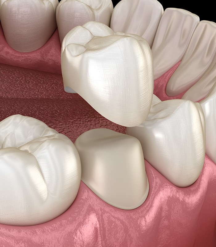 Animated smile during dental crown placement