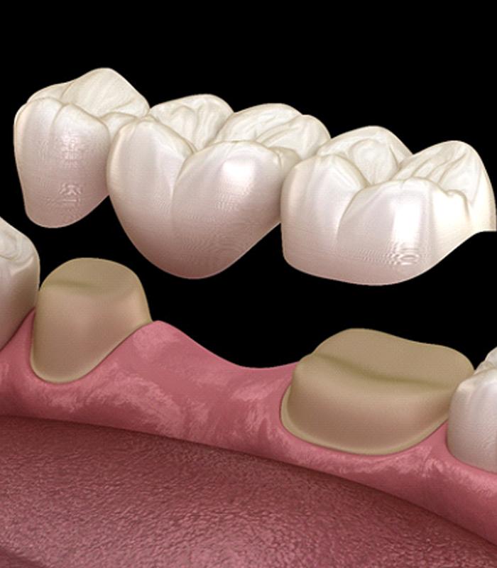 dental bridge in Jonesboro