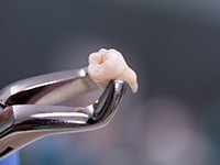 A tooth extraction, which is cheaper compared to the cost of a root canal in Jonesboro