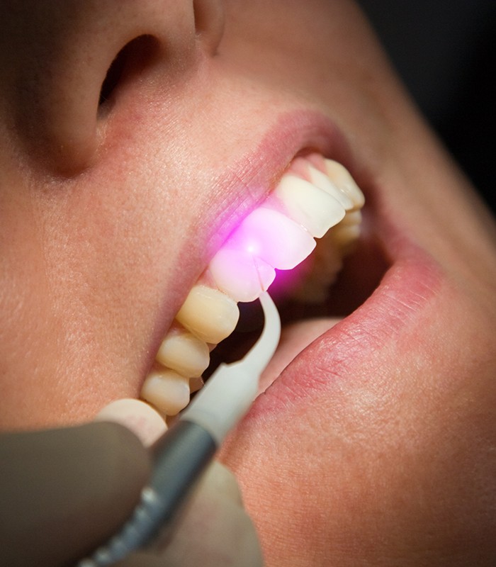 Patient receiving soft tissue laser dentistry