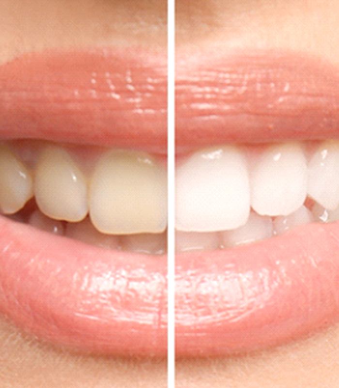Before and after of teeth whitening in Jonesboro