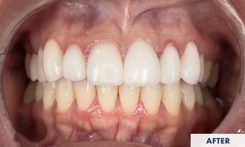 After veneers