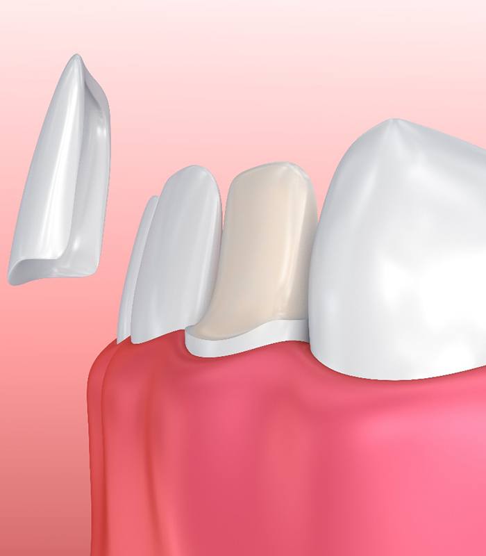 Digital illustration of veneers in Jonesboro