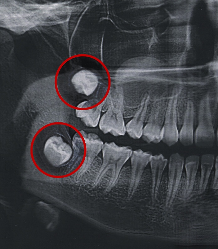 X-ray of smile with impacted wisdom teeth before extraction