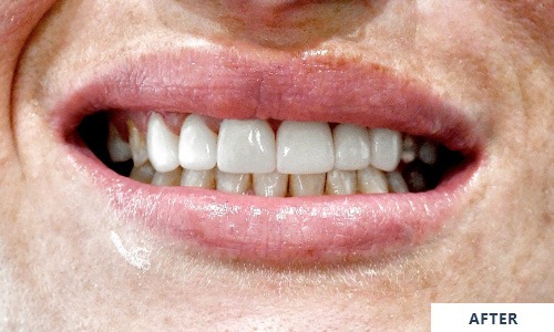 Smile after zirconia crowns