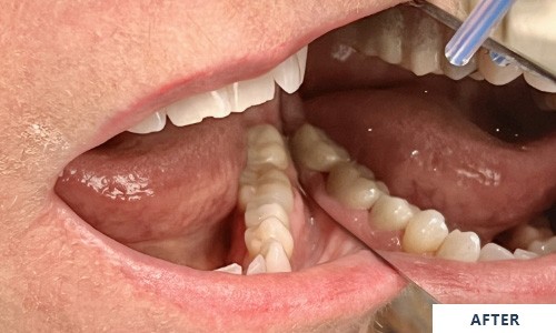 Smile after zirconia crowns