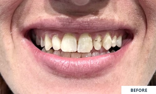 Smile before zirconia crowns