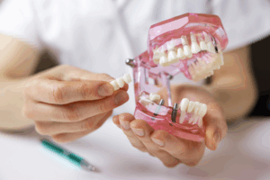 a model of dental implants